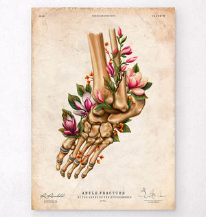 Ankle fracture anatomy print