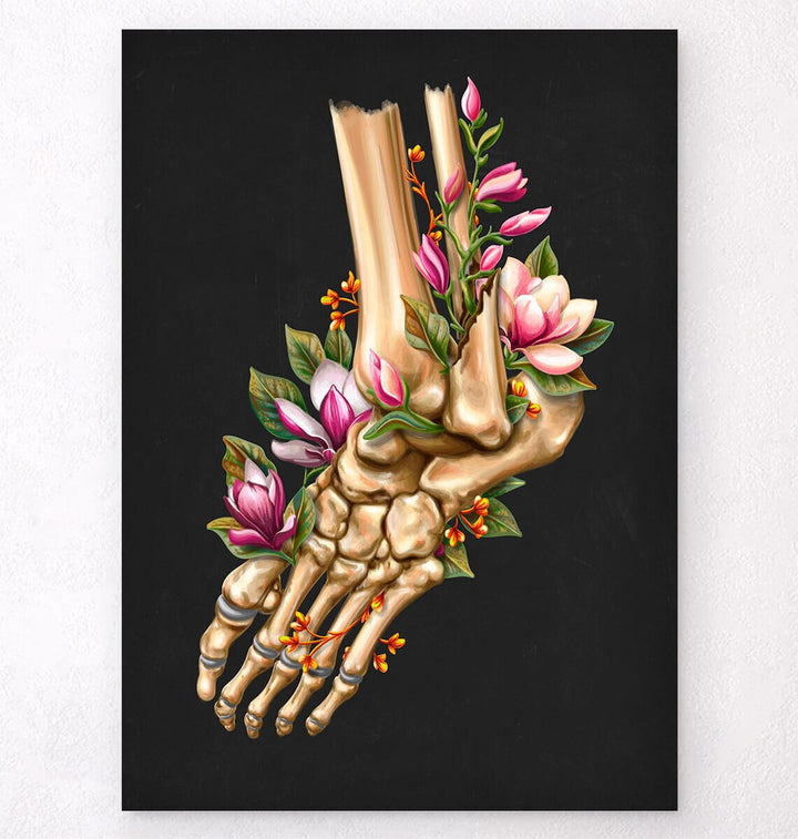 Ankle fracture art print