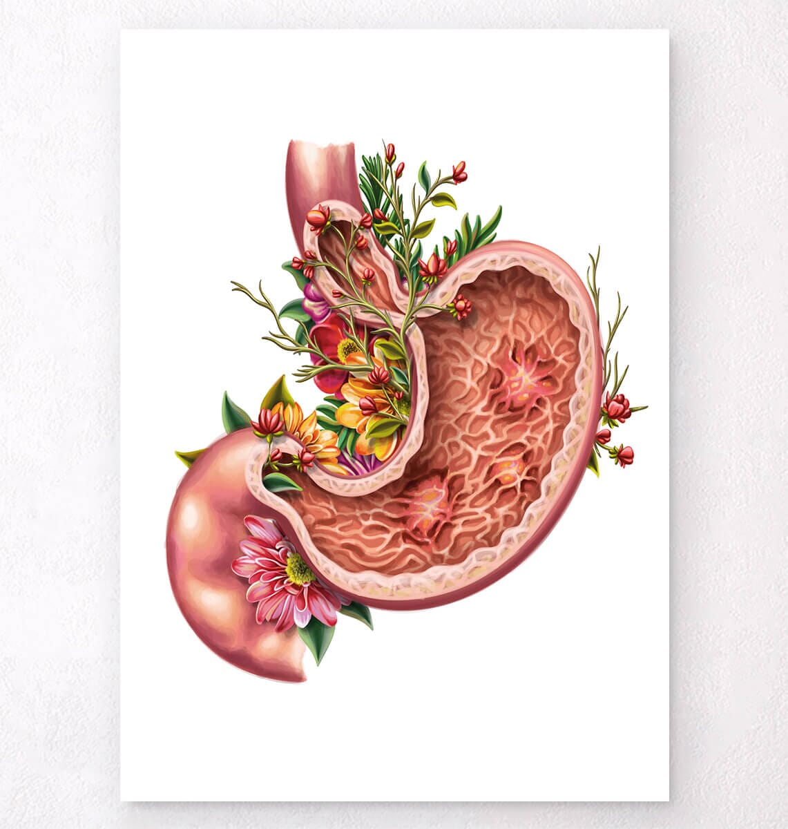 Gastric ulcers anatomy art print by Codex Anatomicus