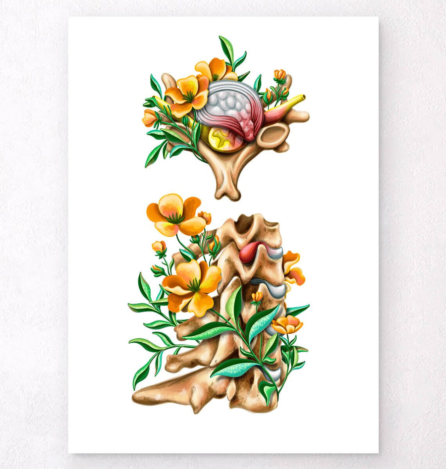 Herniated cervical disc anatomy art